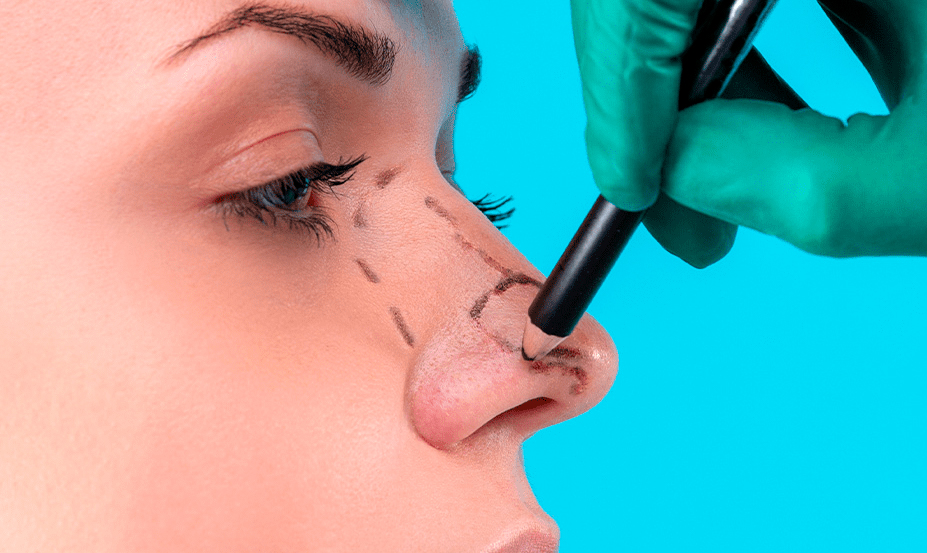 Rinoplastia Funcional y Estetica