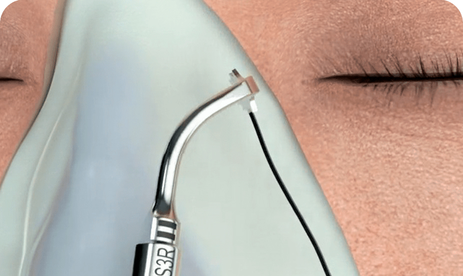 Rinoplastia Ultrasónica
